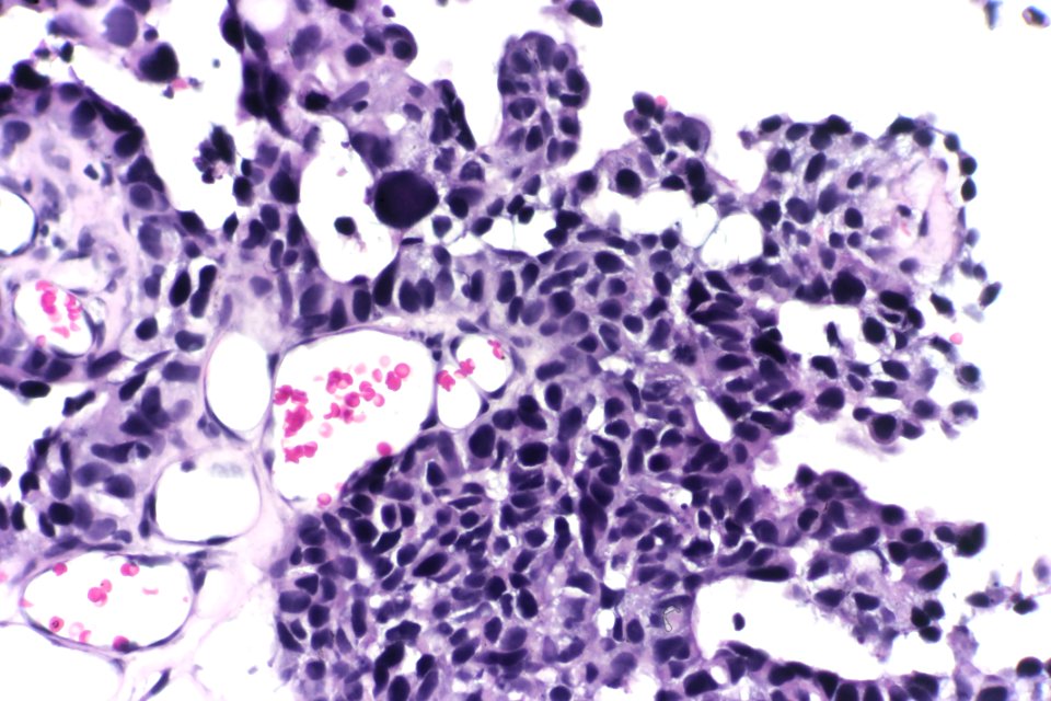High-grade papillary urothelial carcinoma (EVG), very high mag