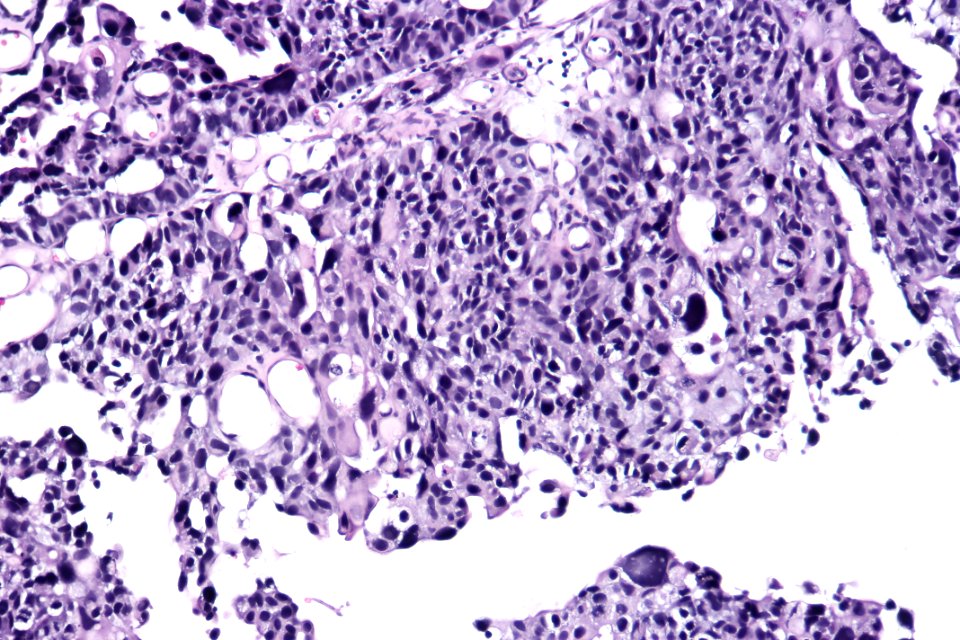 High-grade papillary urothelial carcinoma (EVG), high mag