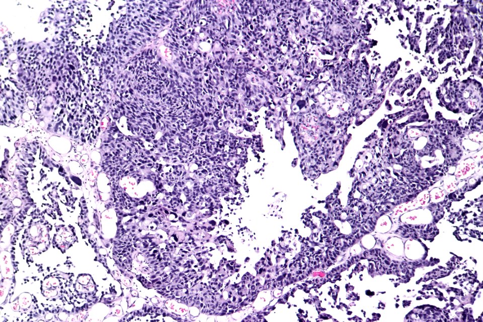 High-grade papillary urothelial carcinoma (EVG), intermed. mag