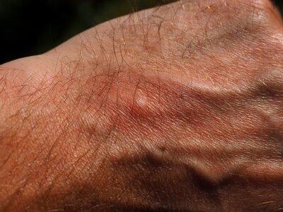Allergy pustules swelling