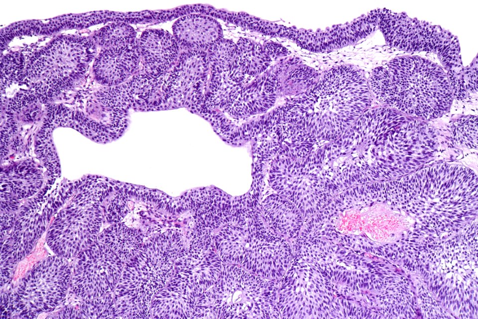 Inverted urothelial papilloma, intermed. mag.1