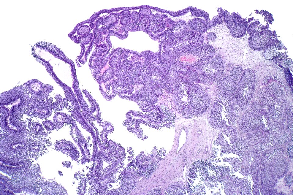 Inverted urothelial papilloma, low mag