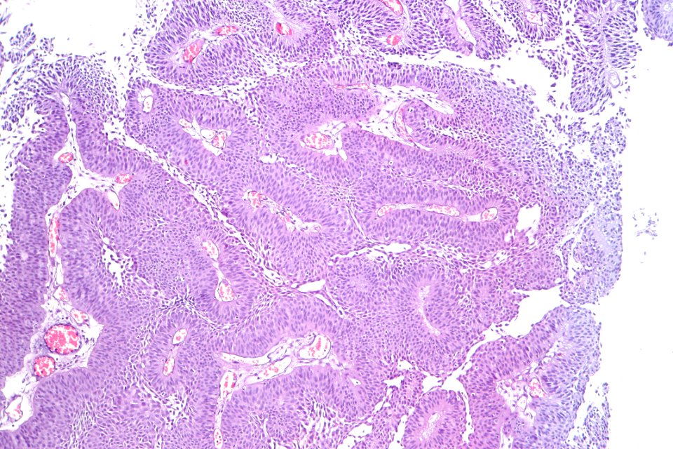 Inverted urothelial papilloma, intermed. mag.2