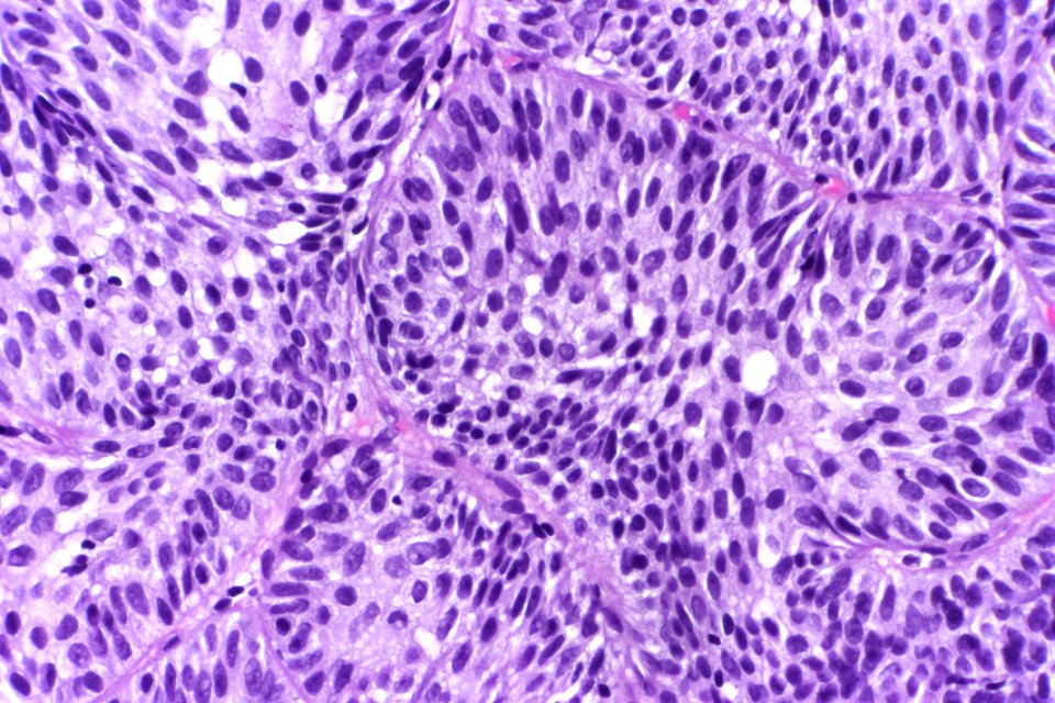 Inverted urothelial papilloma, very high mag