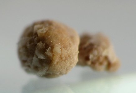 Kidney stone 4mm 05
