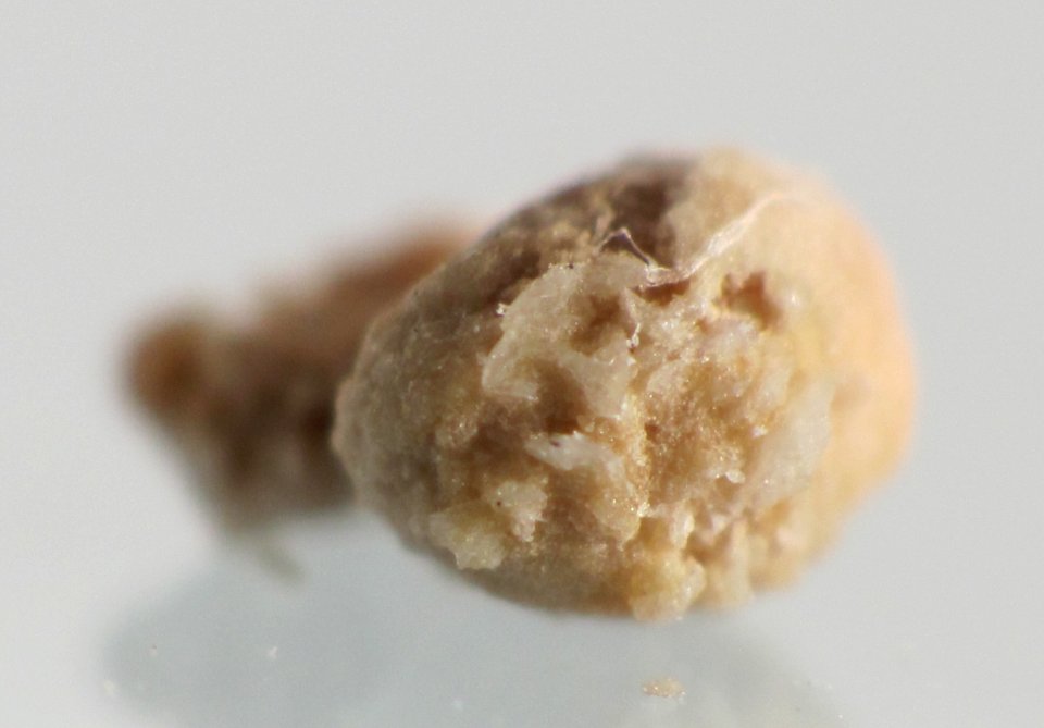 Kidney stone 4mm 03