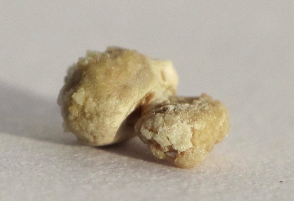 Kidney stone 4mm 02