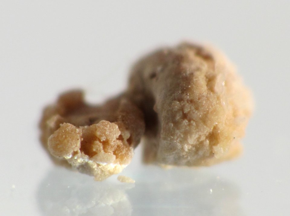 Kidney stone 4mm 04