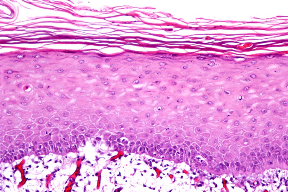 Keratinizing squamous metaplasia of the urinary bladder, high mag.2