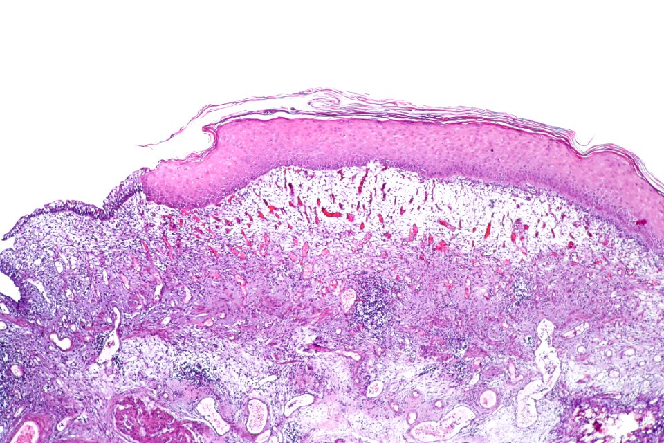 Keratinizing squamous metaplasia of the urinary bladder, low mag