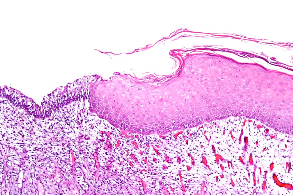 Keratinizing squamous metaplasia of the urinary bladder, intermed. mag