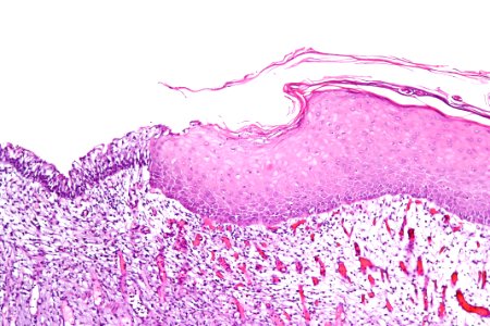 Keratinizing squamous metaplasia of the urinary bladder, intermed. mag
