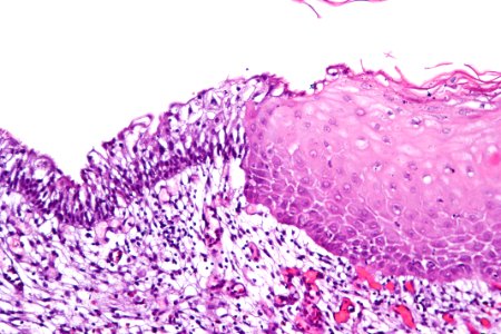 Keratinizing squamous metaplasia of the urinary bladder, high mag.1