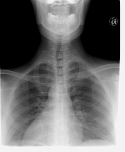 Xray thoracic spine diagnosis