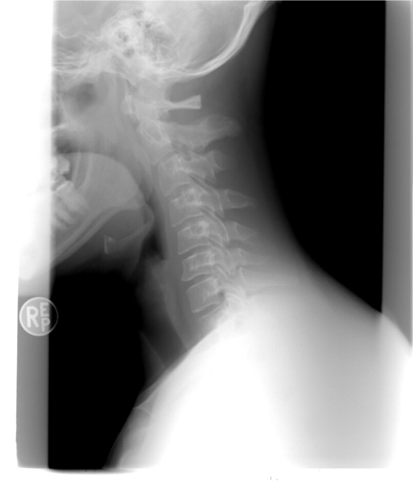 Cervical spine xray patient