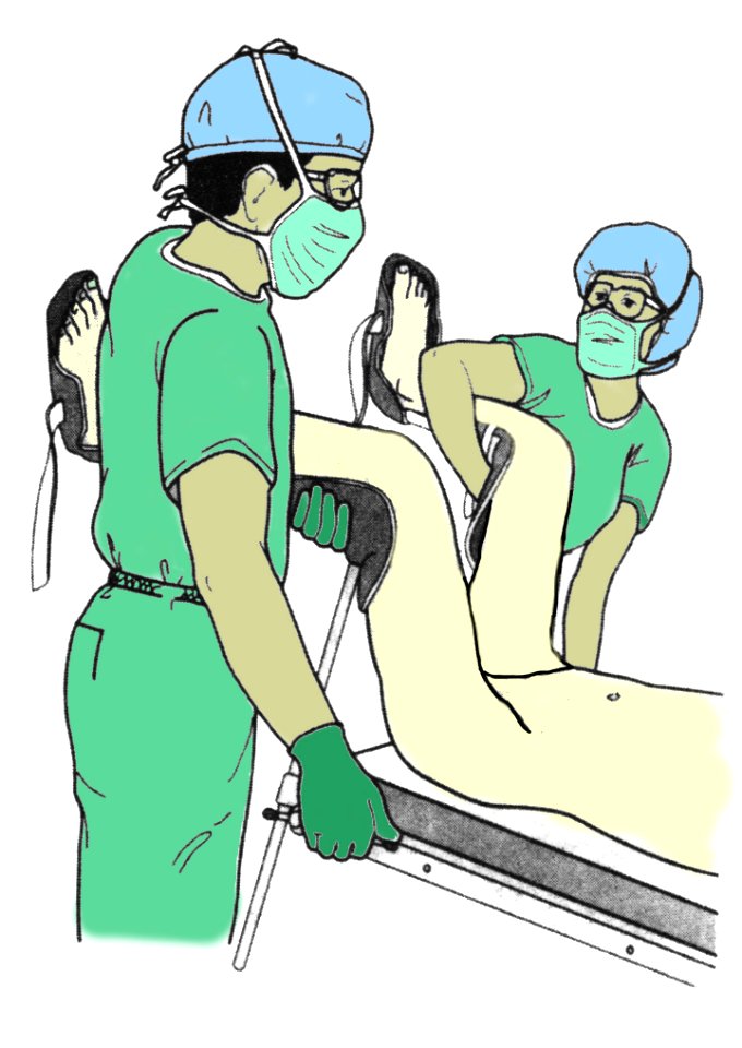 Lithotomy position 01