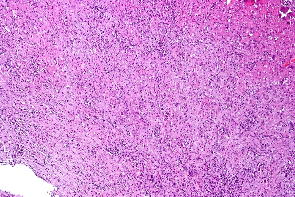 Malakoplakia of the urinary bladder, intermed. mag