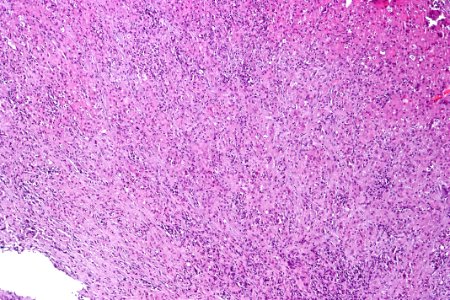 Malakoplakia of the urinary bladder, intermed. mag