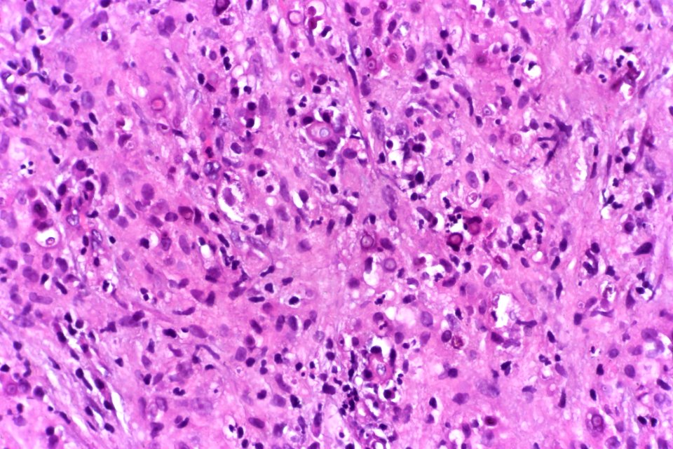 Malakoplakia of the urinary bladder, very high mag