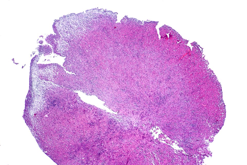 Malakoplakia of the urinary bladder, low mag