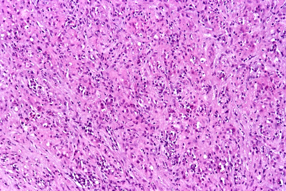 Malakoplakia of the urinary bladder, high mag