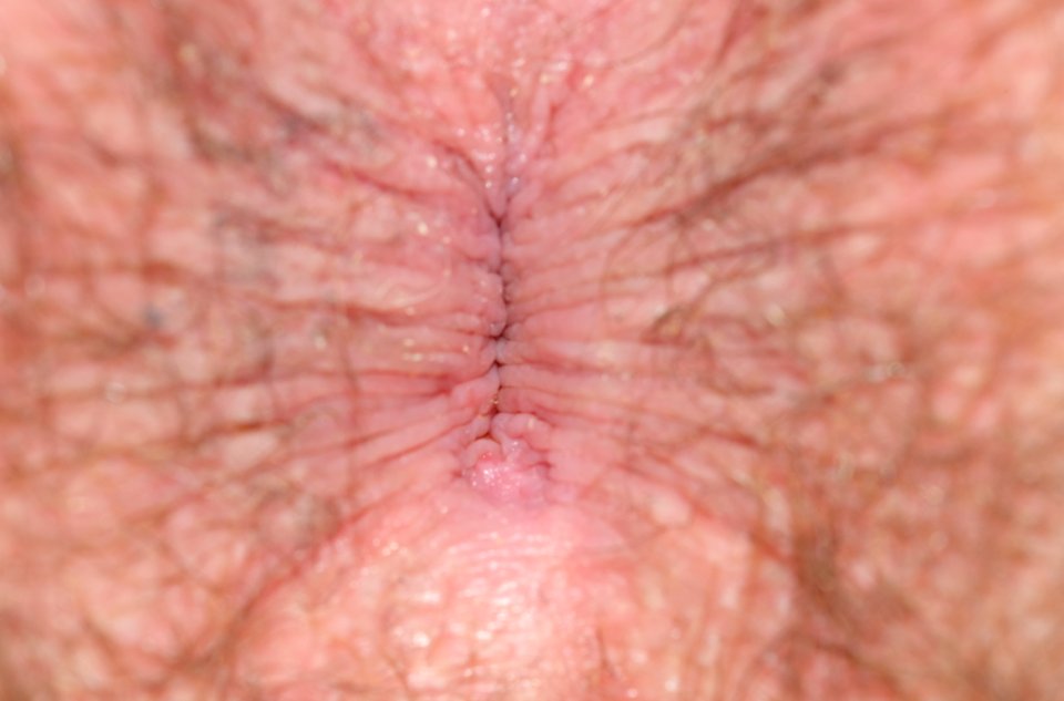 Menselijke anus met gesloten sluitspier