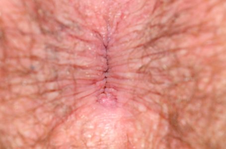 Menselijke anus met gesloten sluitspier