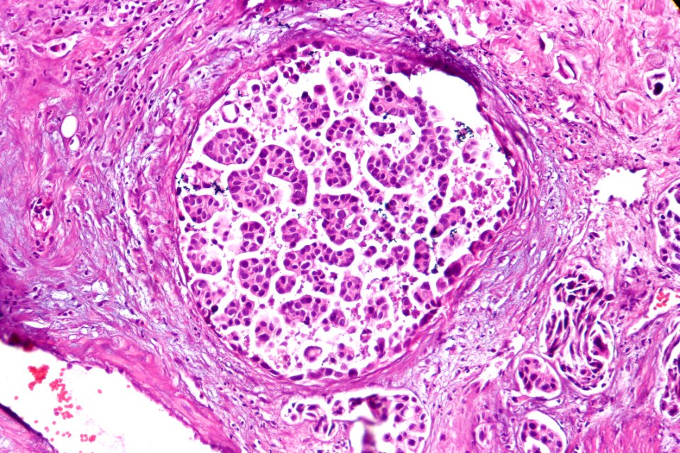 Micropapillary urothelial carcinoma, high mag