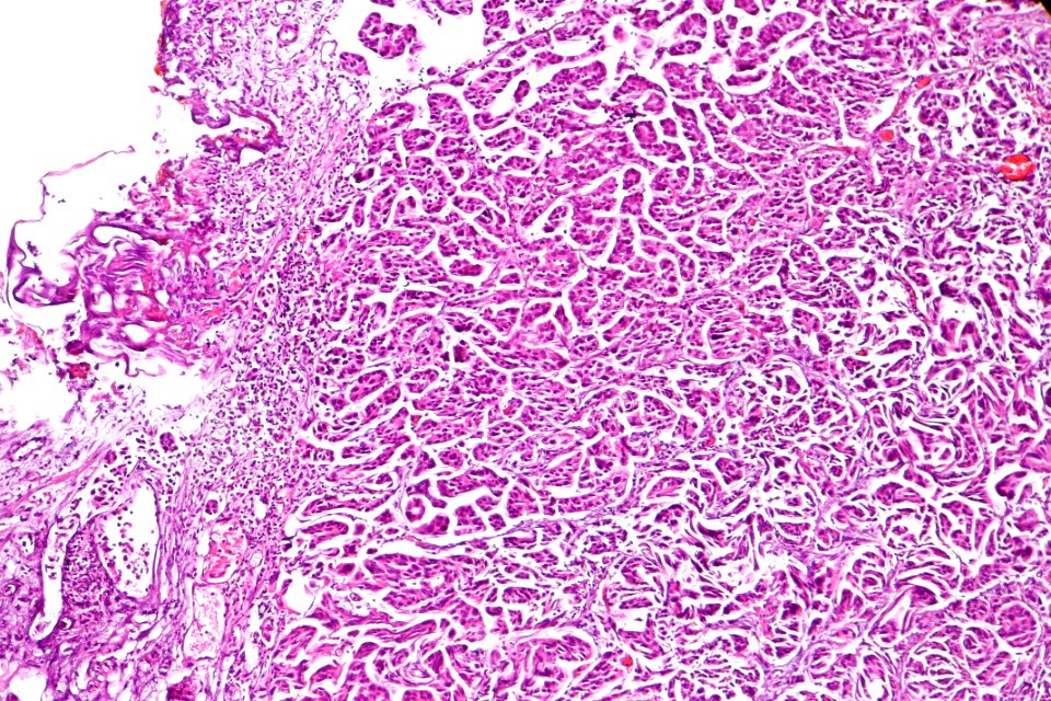 Micropapillary urothelial carcinoma, intermed. mag