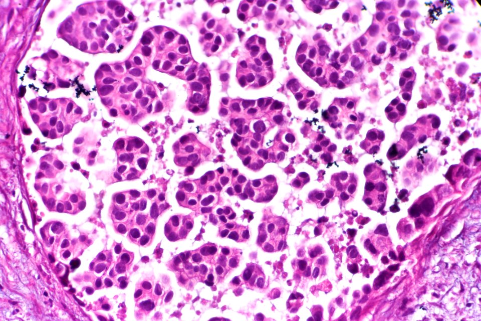 Micropapillary urothelial carcinoma, very high mag