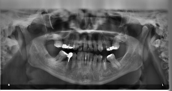 Ugly jaw dental fillings