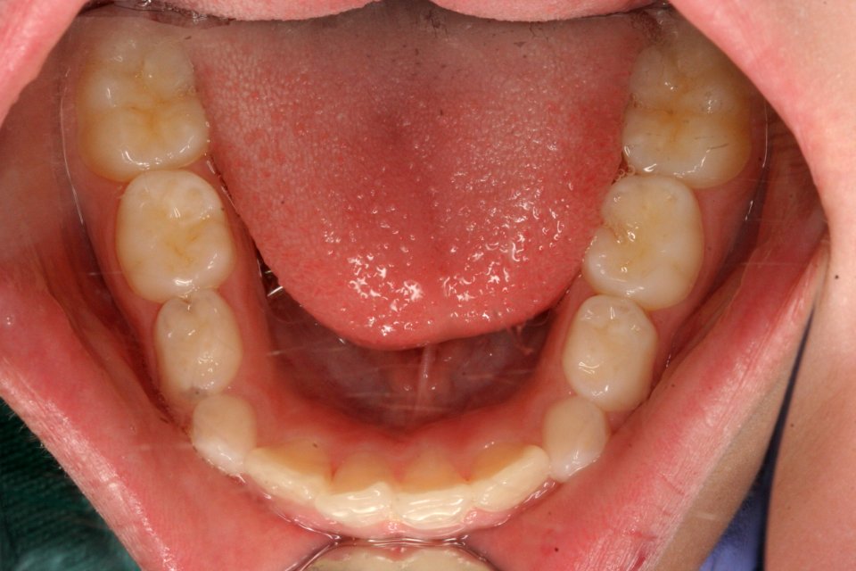 MixedDentition