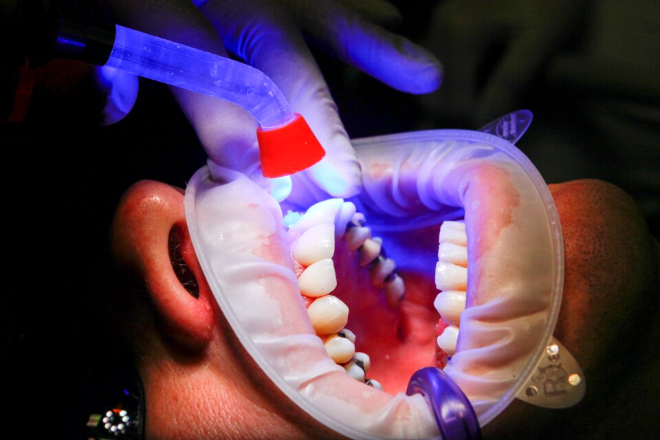 Curing teeth mouth photo