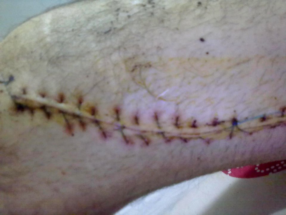 Nonabsorbable sutures in a person 's knee