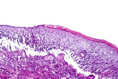 Nonkeratinizing & keratinizing squamous metaplasia of the urinary bladder, high mag