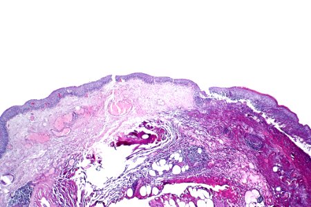 Nonkeratinizing & keratinizing squamous metaplasia of the urinary bladder, low mag