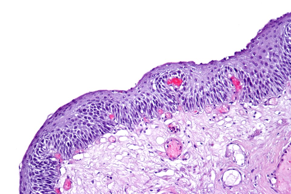 Nonkeratinizing squamous metaplasia of the urinary bladder, high mag