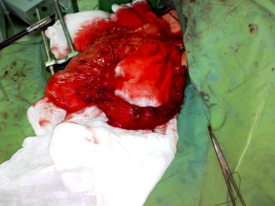 Part of the esophagus and stomach 01
