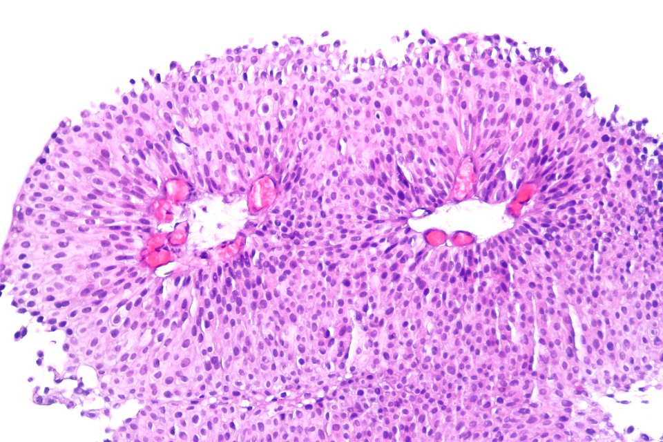 Papillary urothelial carcinoma (low-grade), high mag.3