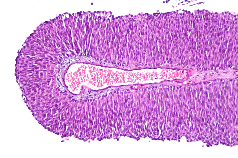 Papillary urothelial carcinoma (low-grade), high mag.2