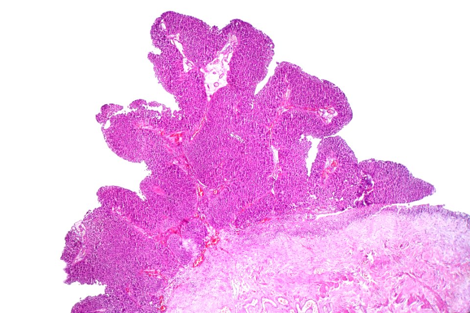 Papillary urothelial carcinoma (low-grade), low mag
