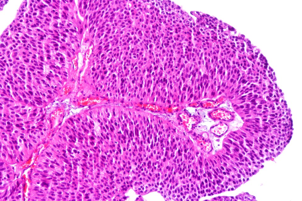 Papillary urothelial carcinoma (low-grade), high mag.1