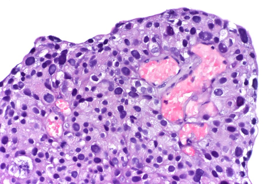Papillary urothelial carcinoma (high-grade), very high mag