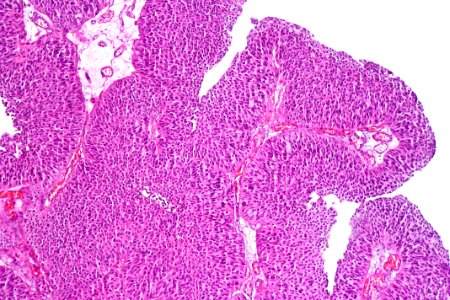 Papillary urothelial carcinoma (low-grade), intermed. mag.1