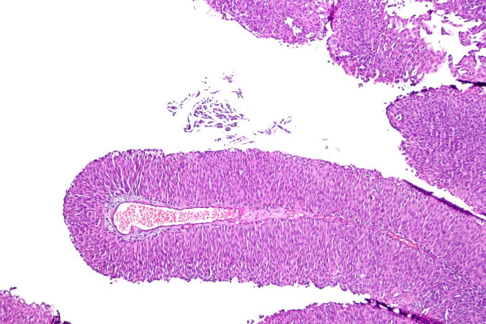 Papillary urothelial carcinoma (low-grade), intermed. mag.2