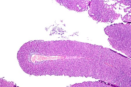 Papillary urothelial carcinoma (low-grade), intermed. mag.2
