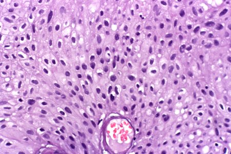 Papillary urothelial carcinoma (low-grade) - inverted variant, very high mag