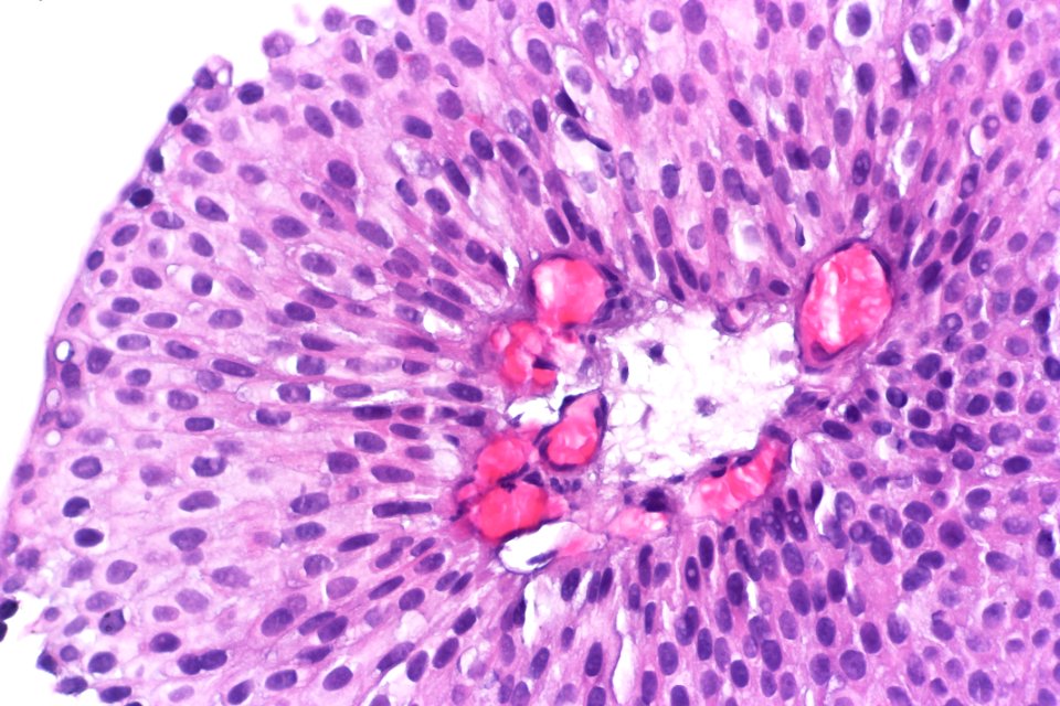 Papillary urothelial carcinoma (low-grade), very high mag.2