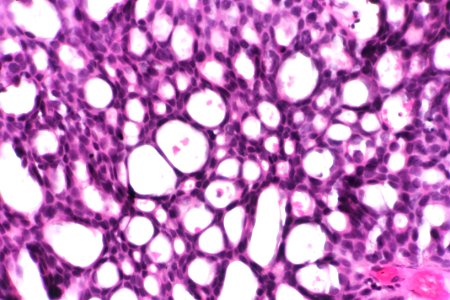 Papillary urothelial carcinoma with cribriform morphology, very high mag