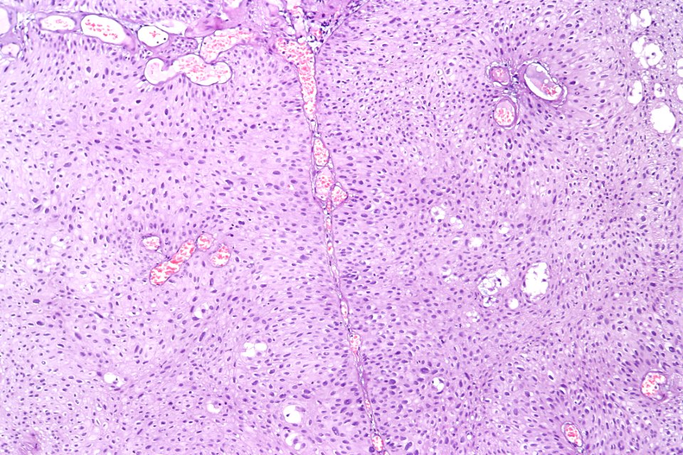 Papillary urothelial carcinoma (low-grade) - inverted variant, intermed. mag